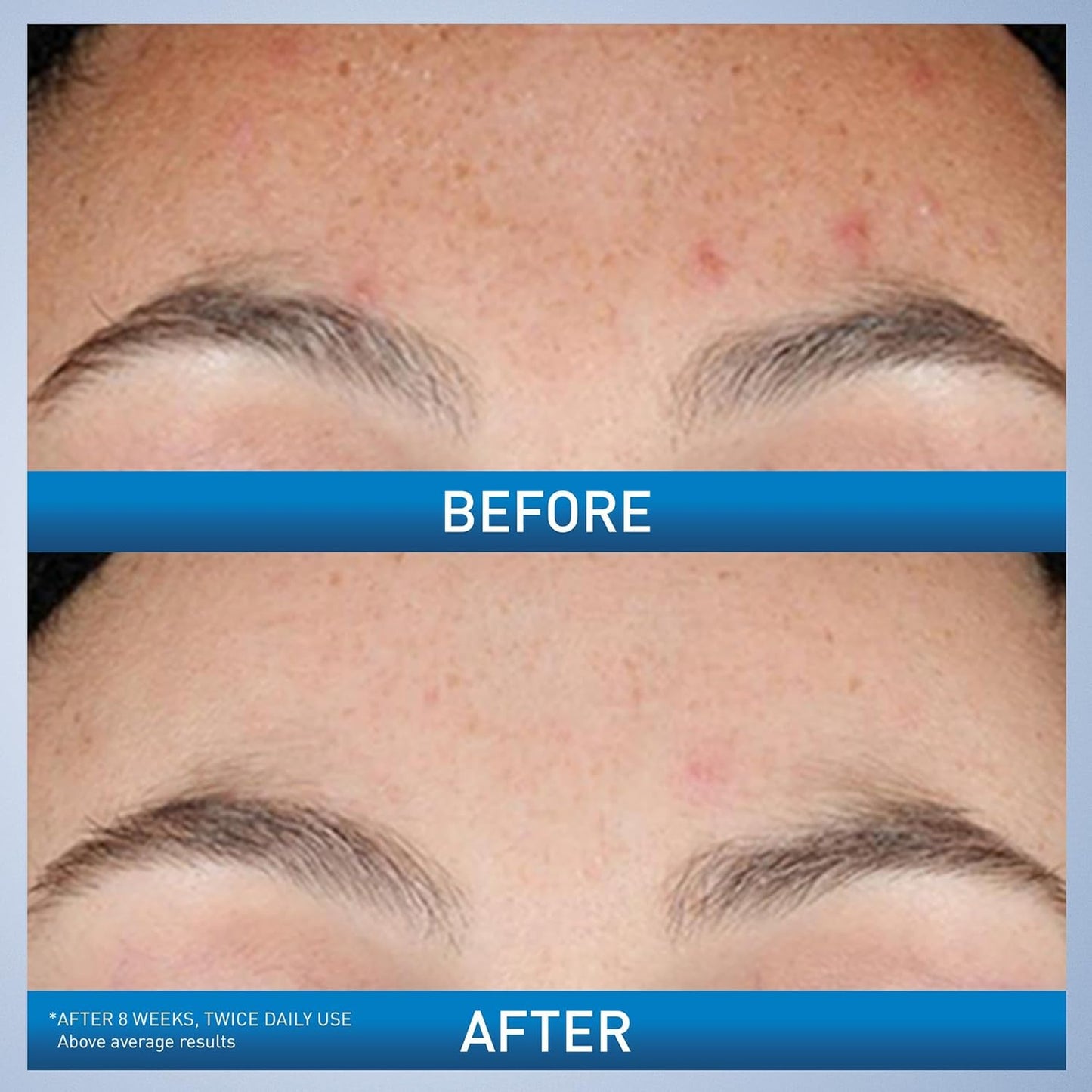 CeraVe Resurfacing Retinol Serum For Post Acne Marks